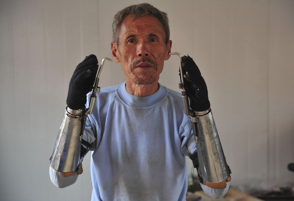 China homemade prosthetic forearms