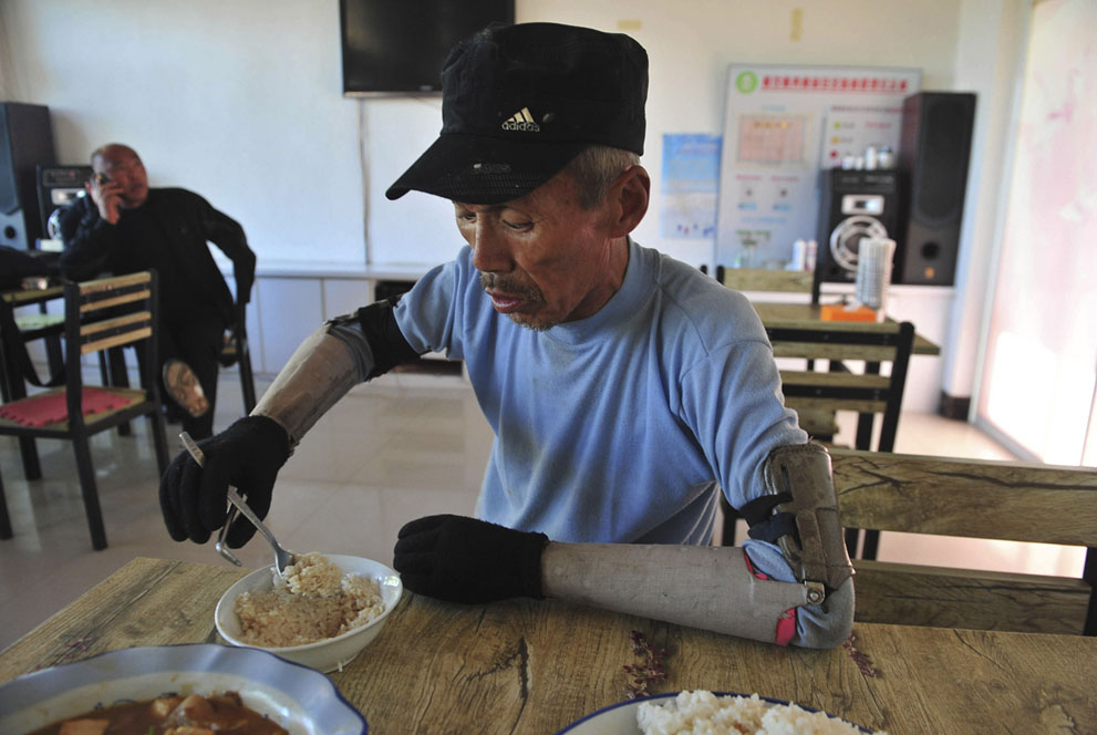 homemade prosthetic forearms in China